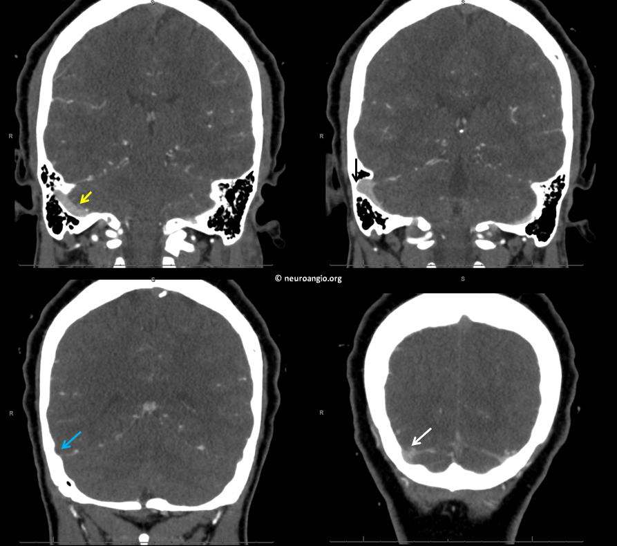 pulsatile-tinnitus-venous-sinus-stenting-neuroangio